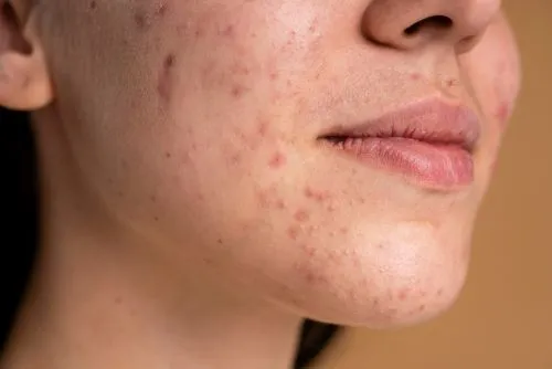 Why Some Acne Marks Turn Darker After Pimples Heal