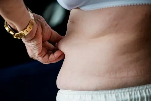 Can Fat Come Back After Liposuction?