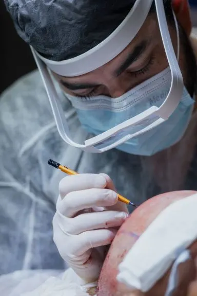 Hair Transplant Myths That Still Confuse Patients