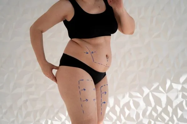 Hi-Def Liposuction: Sculpting, Not Just Fat Removal