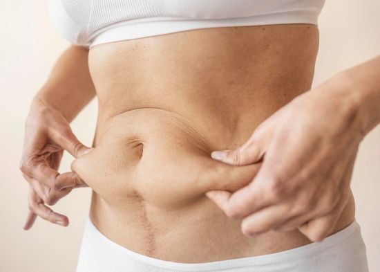 Liposuction Versus Tummy Tuck