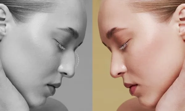 Rhinoplasty: Cosmetic vs Functional Nose Surgery