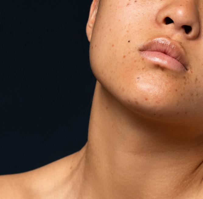 treatment for dark spots on skin