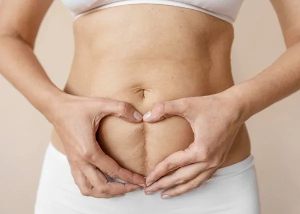 C-Section Scar Revision: When Is the Right Time?