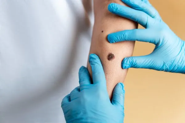 Mole, Wart & DPN Removal: What's the Difference?
