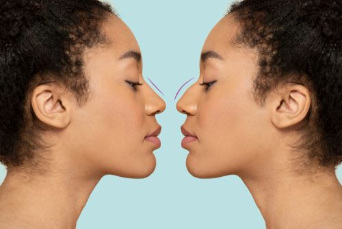 Rhinoplasty