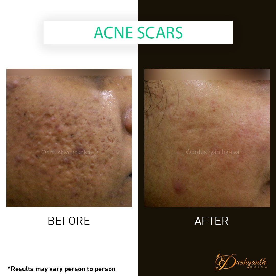 Skin Treatment