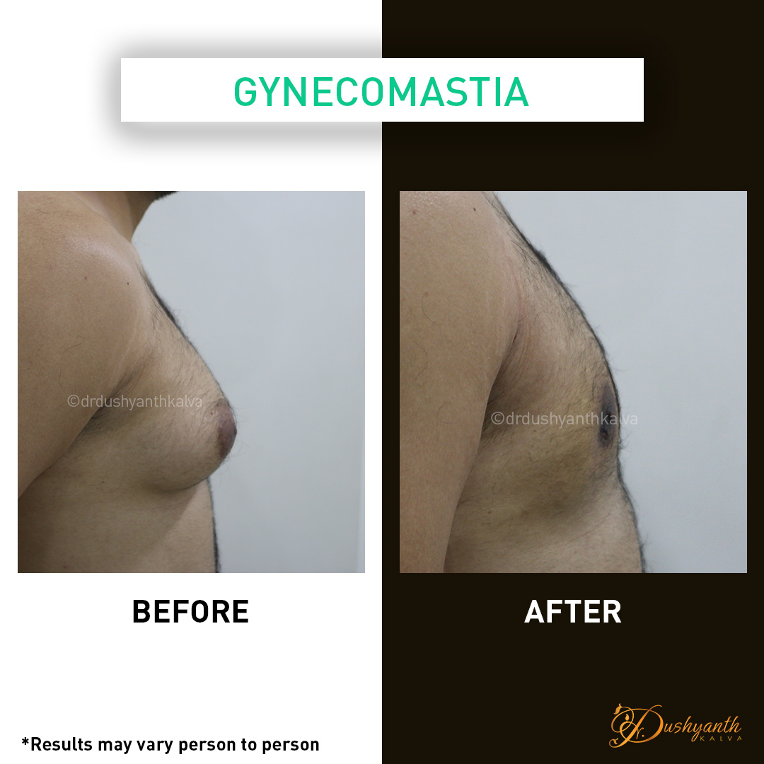 Gynecomastia Surgery Results Hyderabad