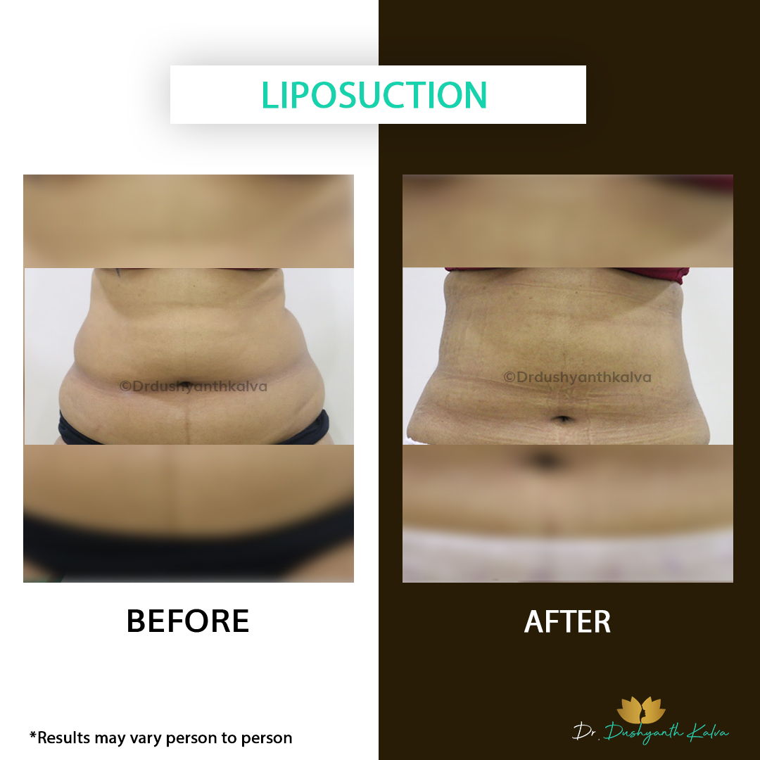 Liposuction Results Hyderabad
