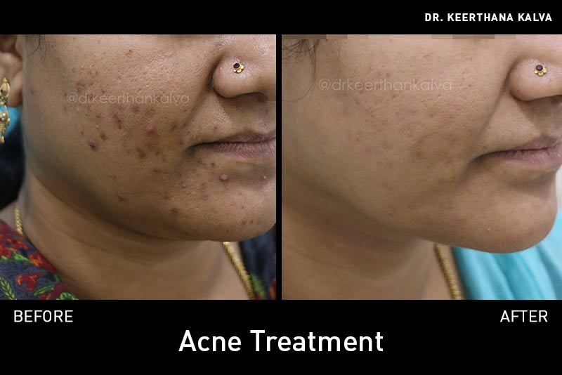 AcneTreatment