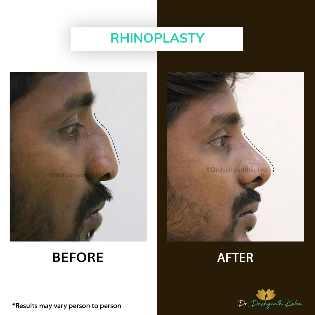 nose reshaping results Hyderabad