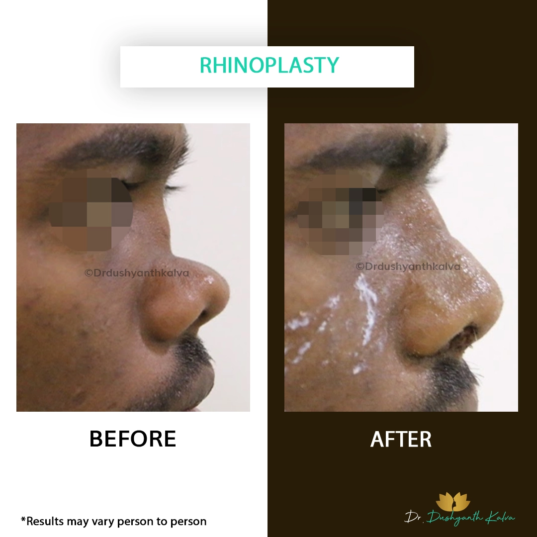nose surgery results Hyderabad