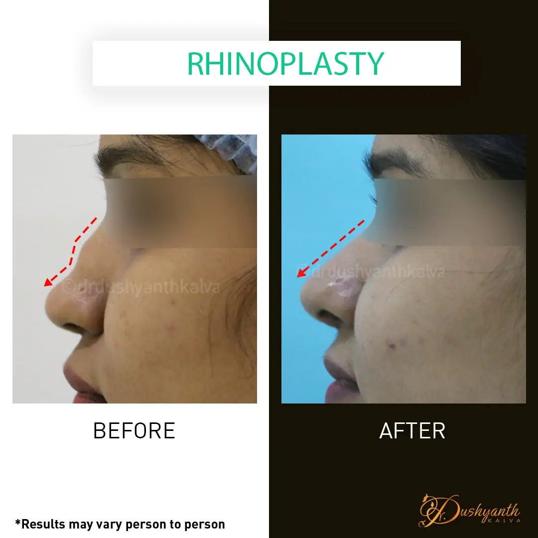 rhinoplasty before after Hyderabad