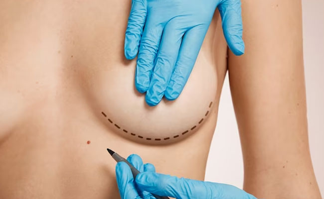 Breas-t Surgery