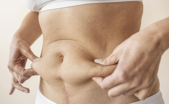 Liposuction