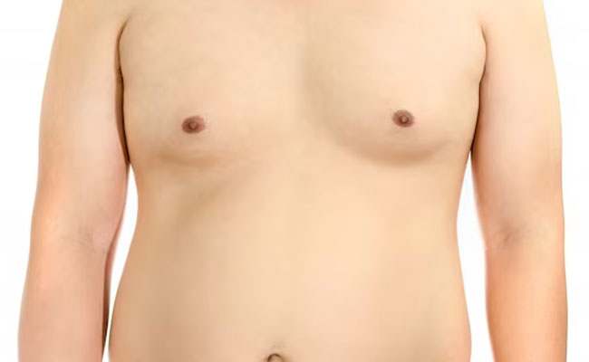 Gynecomastia
